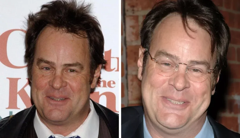 Dan Aykroyd with complete heterochromia